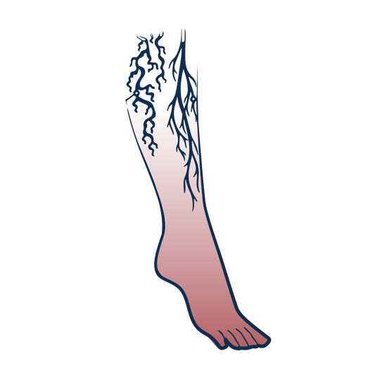 Varices